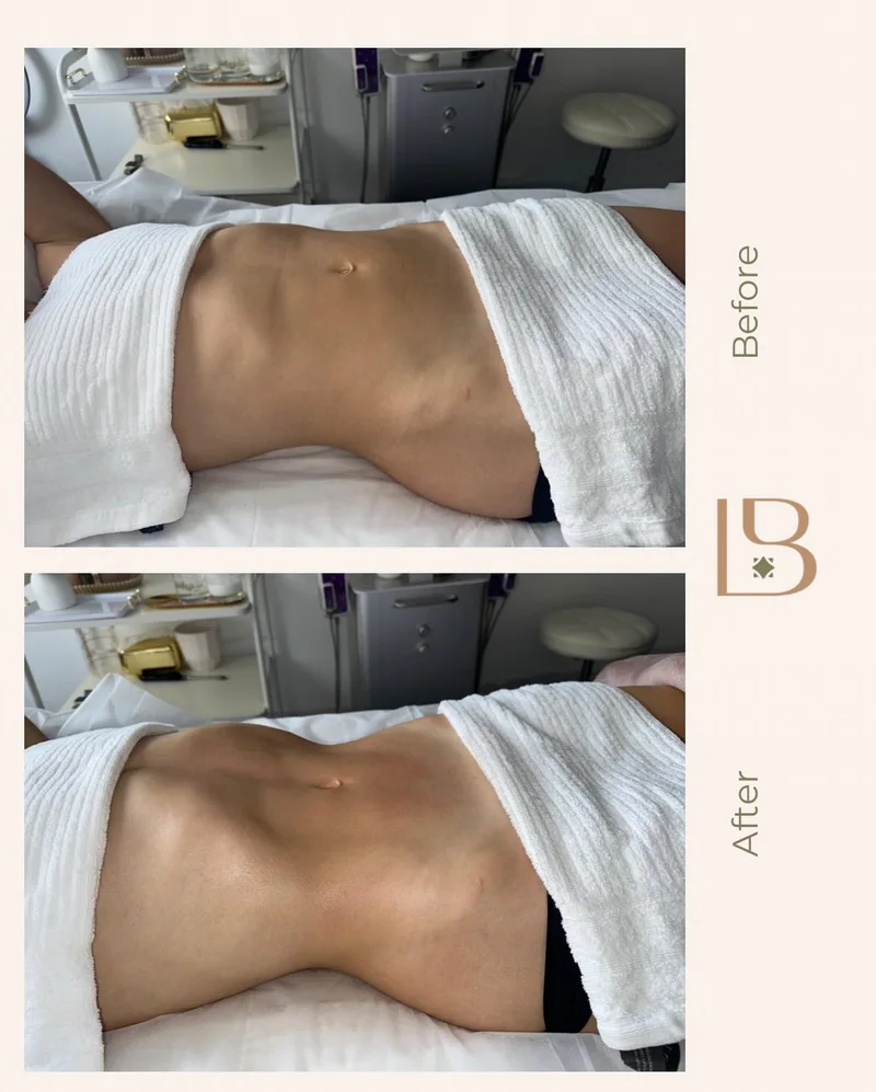 Before and after Brazilian lymphatic drainage, abdomen