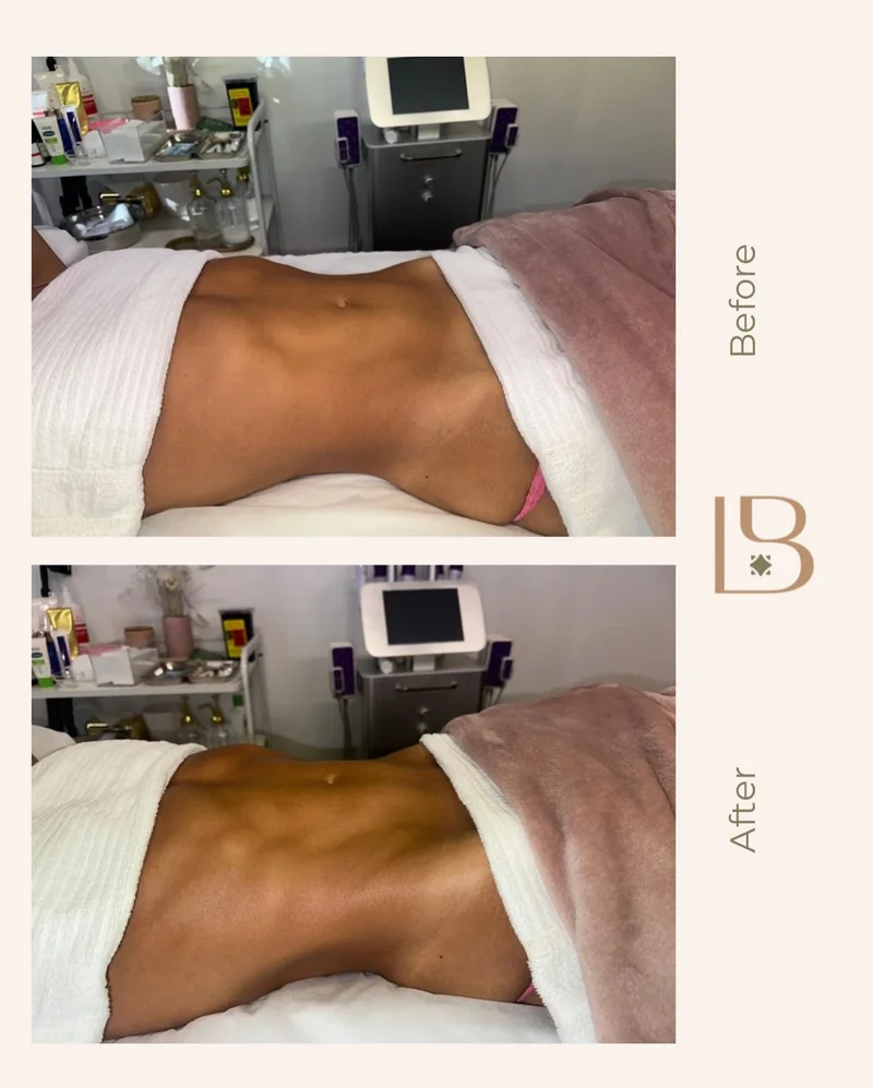 Before and after Brazilian lymphatic drainage, abdomen
