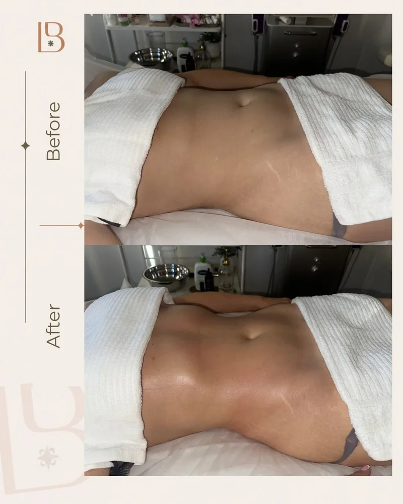 Before and after Brazilian lymphatic drainage, abdomen