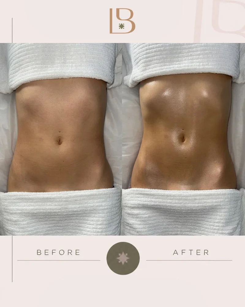 Before and after Brazilian lymphatic drainage, abdomen